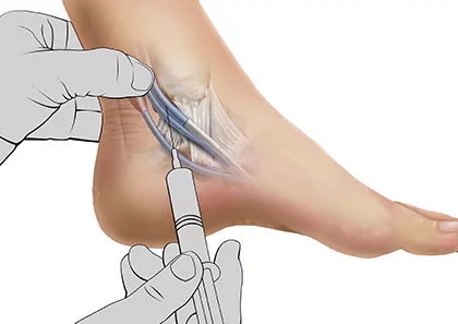 NYC Ankle Injection Doctors