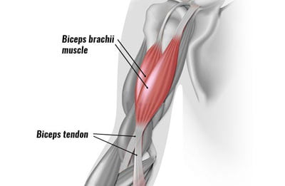 Tratamiento de la tendinitis del bíceps NYC