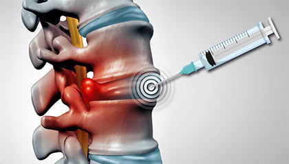 Cervical Epidural Steroid Injection in NYC