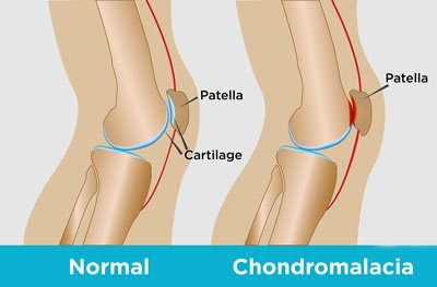 NYC Chondromalacia Patella Treatment Doctors