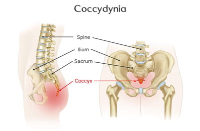 🥇 NYC Coccydynia (Tailbone Pain) Treatment, Causes