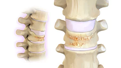Compression Fracture Treatment in NYC
