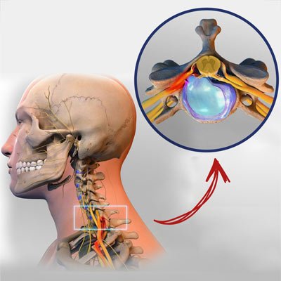 Tratamiento de la enfermedad degenerativa del disco cervical en NYC