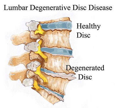 Degenerative Disk Disease Treatment NYC