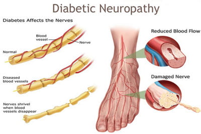 Tratamiento de la neuropatía diabética NYC