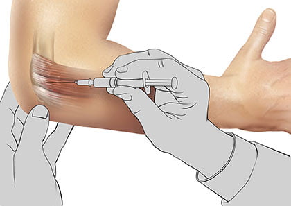 Elbow Injections (platelet-rich plasma, PRP) in NYC