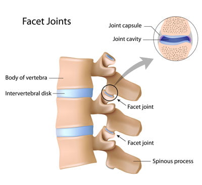 Tratamiento del síndrome de la articulación facetaria en Nueva York