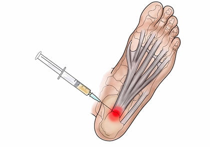 Heel spur shot outlet