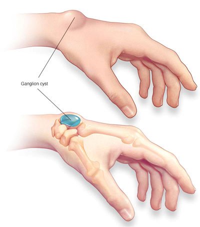 Ganglion Cyst Treatment in NYC