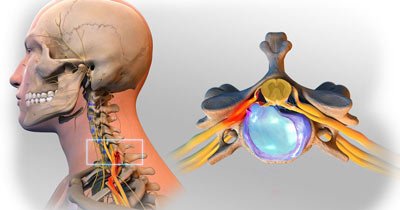 Tratamiento de la hernia discal en el cuello en NYC