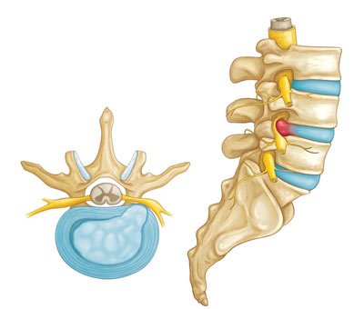 Tratamiento de la hernia discal en NYC