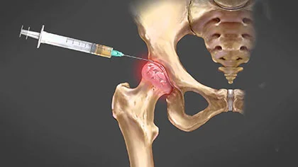 where to inject bpc 157 for hip pain where to get bpc 157 injections 🌟 Healing Power of BPC-157 Peptide  Therapy! 🌟 From promoting tissue repair to reducing inflammation, this  revolutionary treatment offers a multitude of benefits for