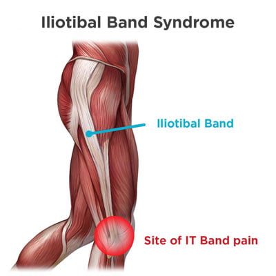 Tratamiento del síndrome de la cintilla iliotibial en Nueva York