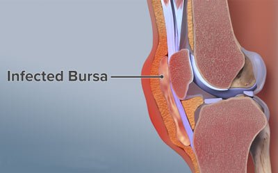 Tratamiento de la bursitis de rodilla en NYC