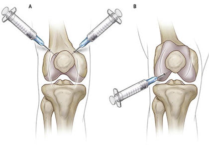Knee Injection for Osteoarthritis in NYC