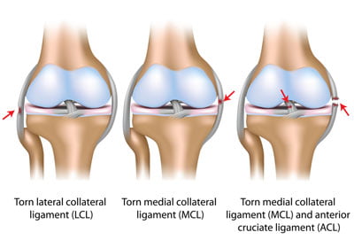 Desgarro de ligamentos de la rodilla Tratamiento NYC