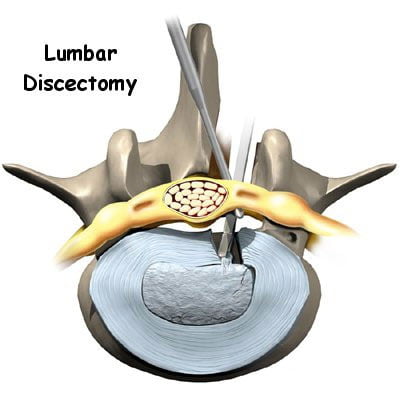 Cirugia de Discectomia Lumbar en NYC