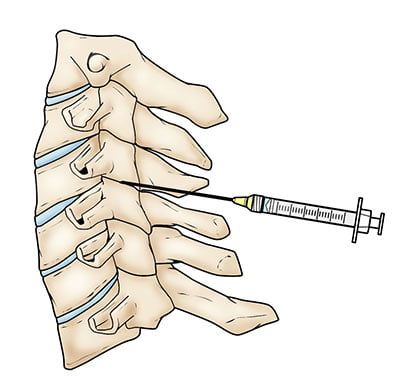 Lumbar Epidural Steroid Injection in NYC
