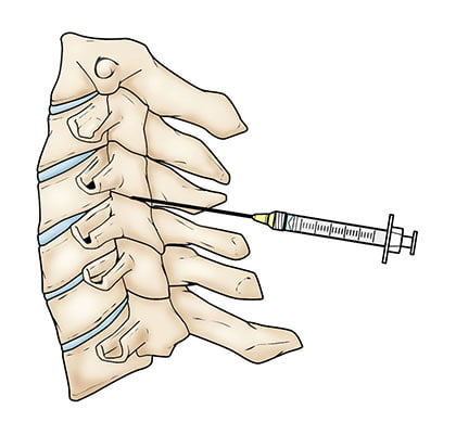 Inyección epidural lumbar de esteroides en NYC