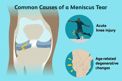 Meniscus Tear Treatment in NYC