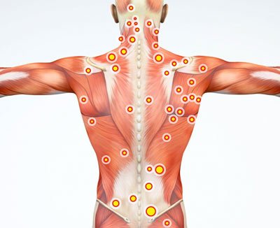 Myofascial Pain Syndrome Treatment NYC