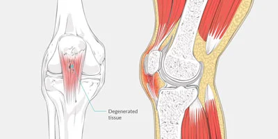 Patellar Tendonitis Treatment in NYC