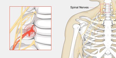 Can Working Out Cause a Pinched Nerve?