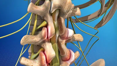 Post-Laminectomy Syndrome Treatment NYC