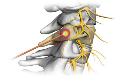 Radiofrequency Ablation (RFA) in NYC