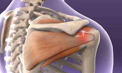 Rotator Cuff Tear Treatment NYC