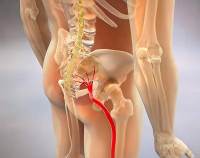 Sciatica Treatment in NYC | Best Sciatica Doctor in New York City