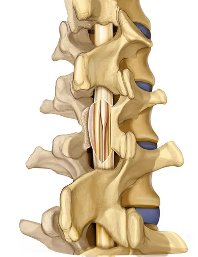 Selective Dorsal Rhizotomy in NYC