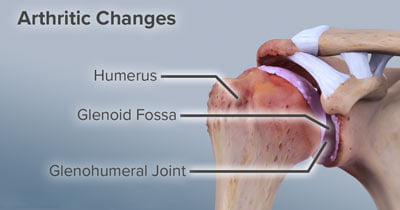 Tratamiento de la artritis de hombro en NYC