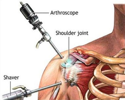 Shoulder Impingement Treatment NYC