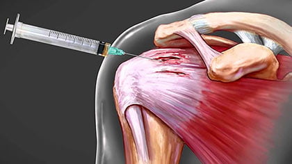 Shoulder Joint Injection Posterior Approach