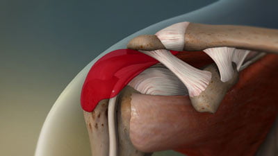 Tratamiento de la tendinitis de hombro en NYC