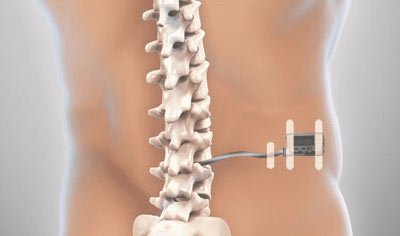 Spinal Cord Stimulator in NYC