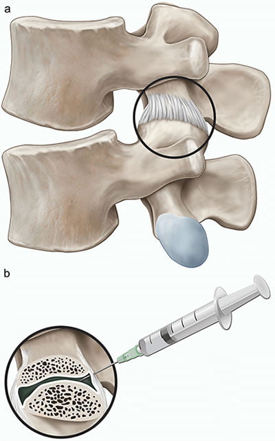 Spine Facet Injection in NYC