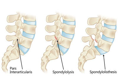 Tratamiento de la espondilolistesis en NYC