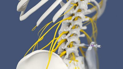 Lumbar Sympathetic Nerve Block in NYC