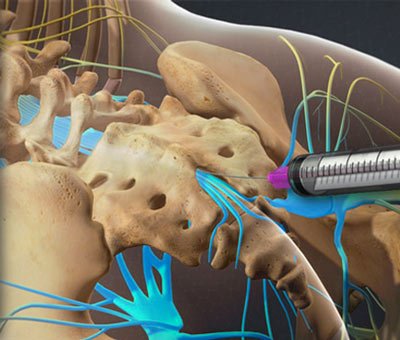 Inyección epidural torácica en NYC