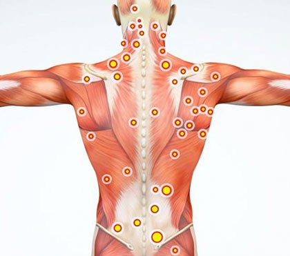 Trigger Point Injections