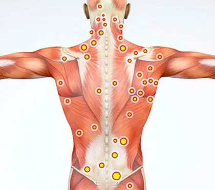 Trigger Point Injections
