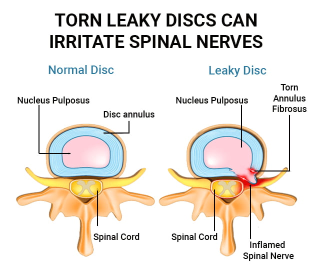 Torn leaky discs