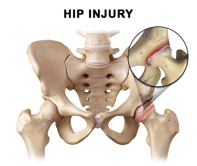 Hip pain Information  Mount Sinai - New York