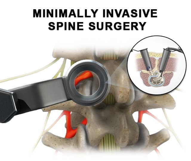 minimally invasive spine surgery