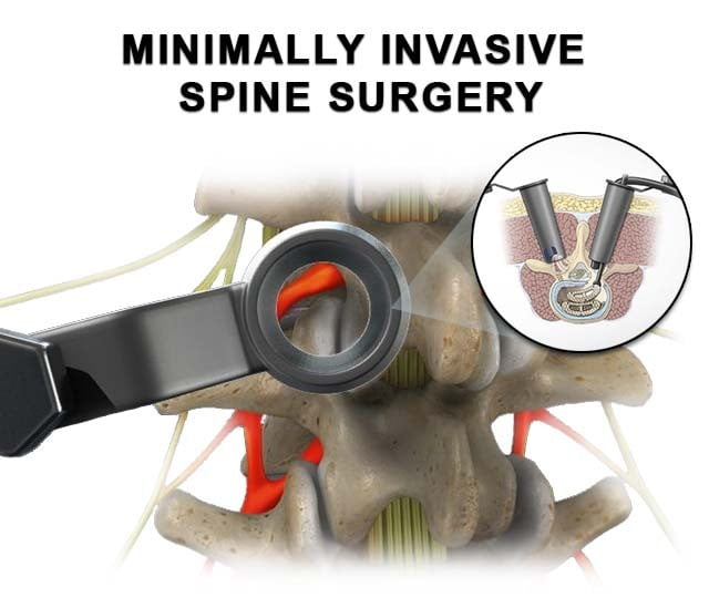 cirugía mínimamente invasiva de la columna vertebral