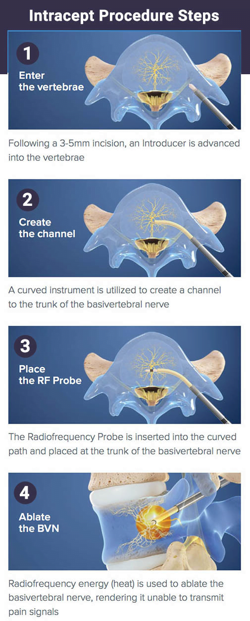 Pasos del procedimiento Intracept