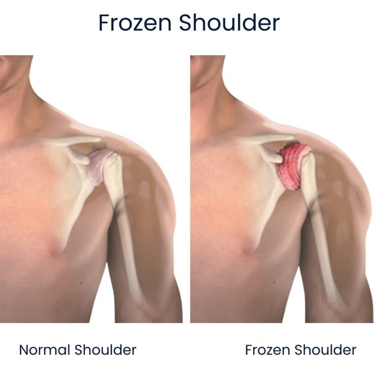 Frozen Shoulder Treatment NYC Shoulder Pain Doctors New York
