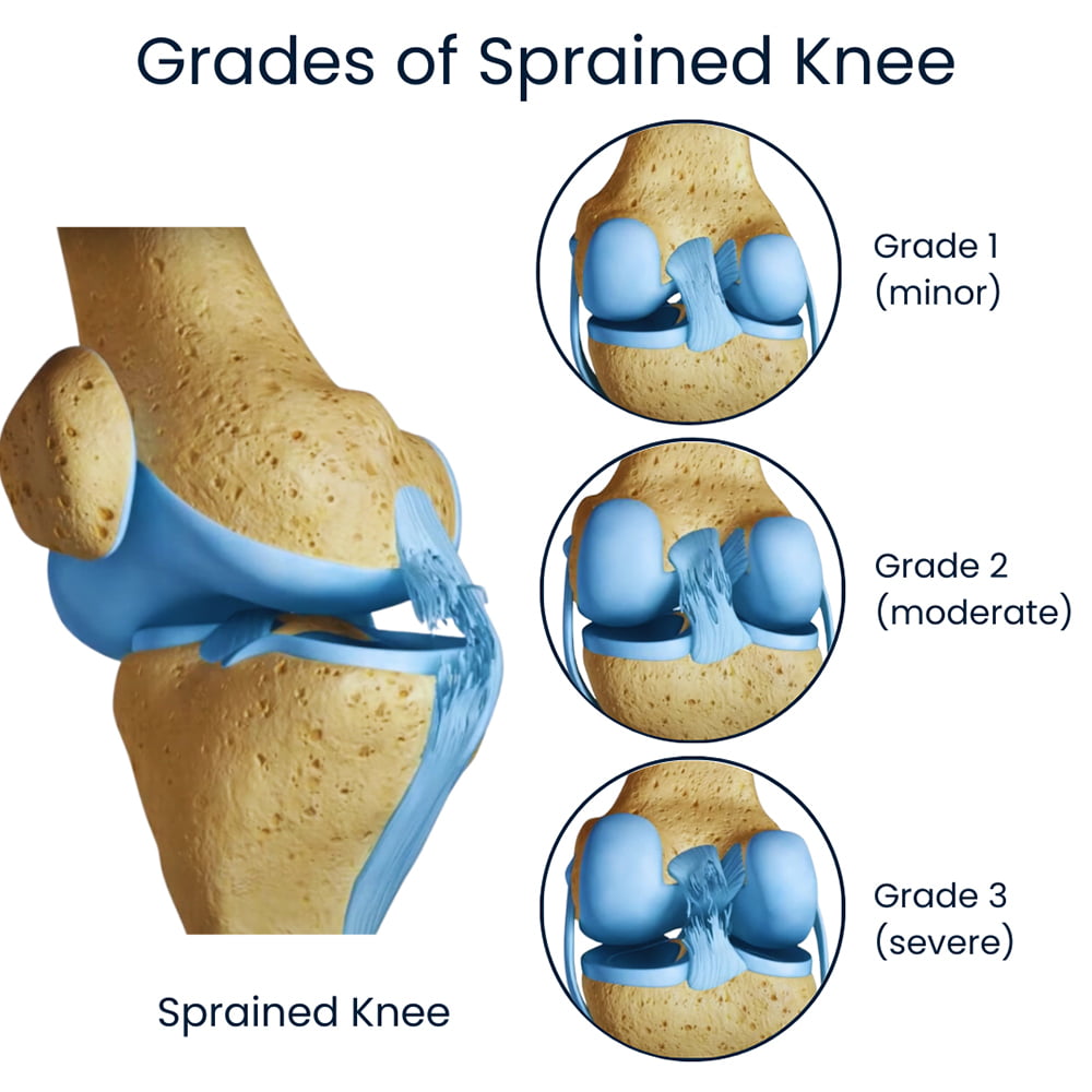 Grados del esguince de rodilla